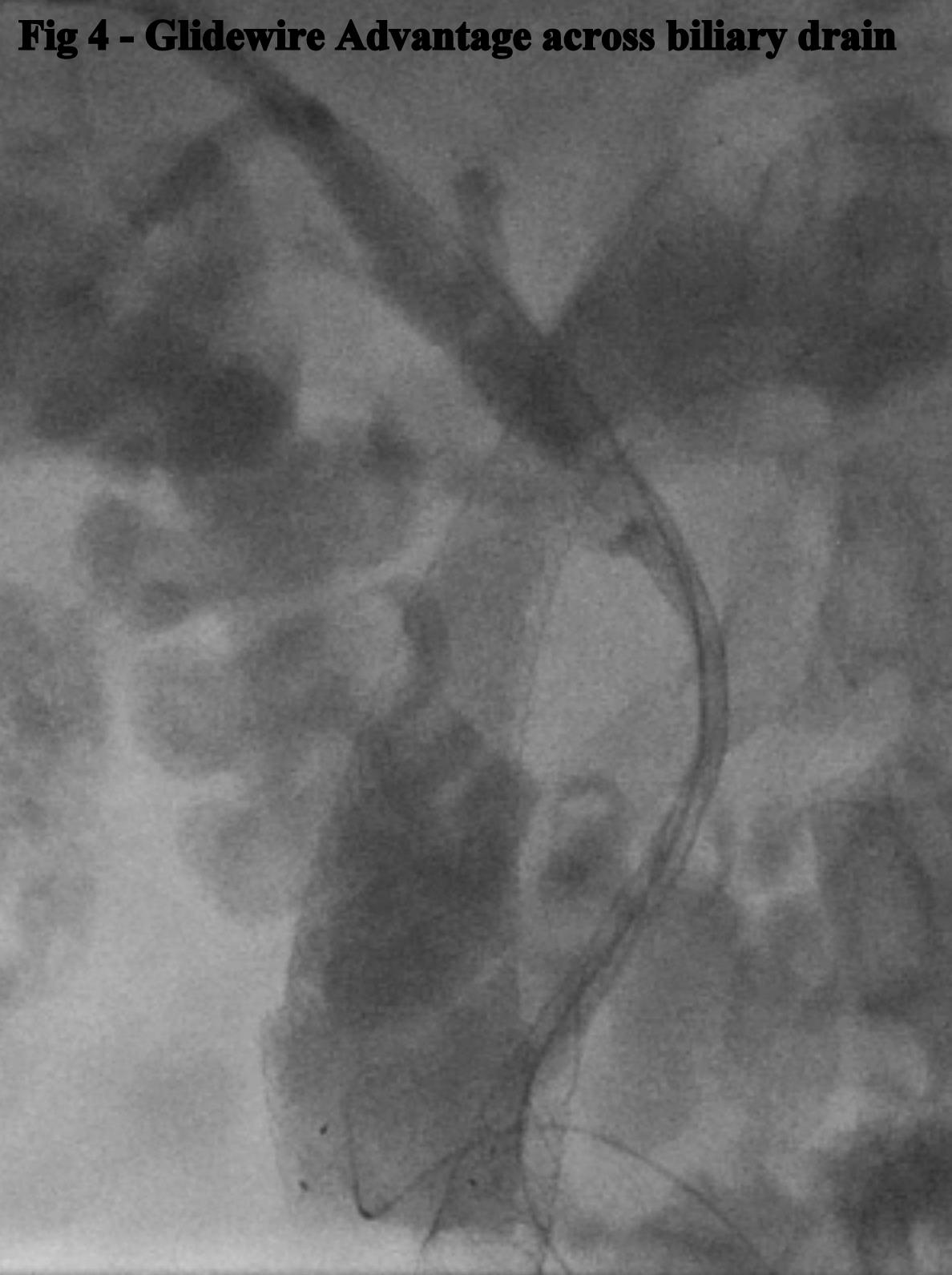 Fig 4. Glidewire Advantage across biliary drain